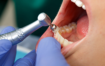 professional dental brushing