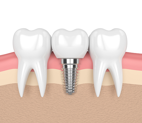 Diagram of dental implant