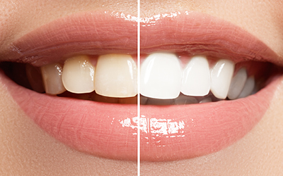 whitening smile before and after