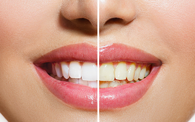 Teeth before and after whitening