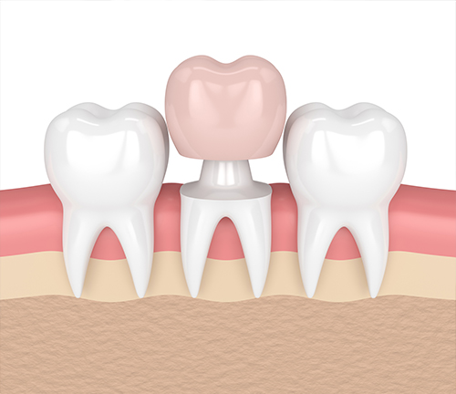 Diagram of dental crown