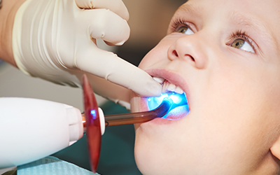 Dental Filing of child tooth
